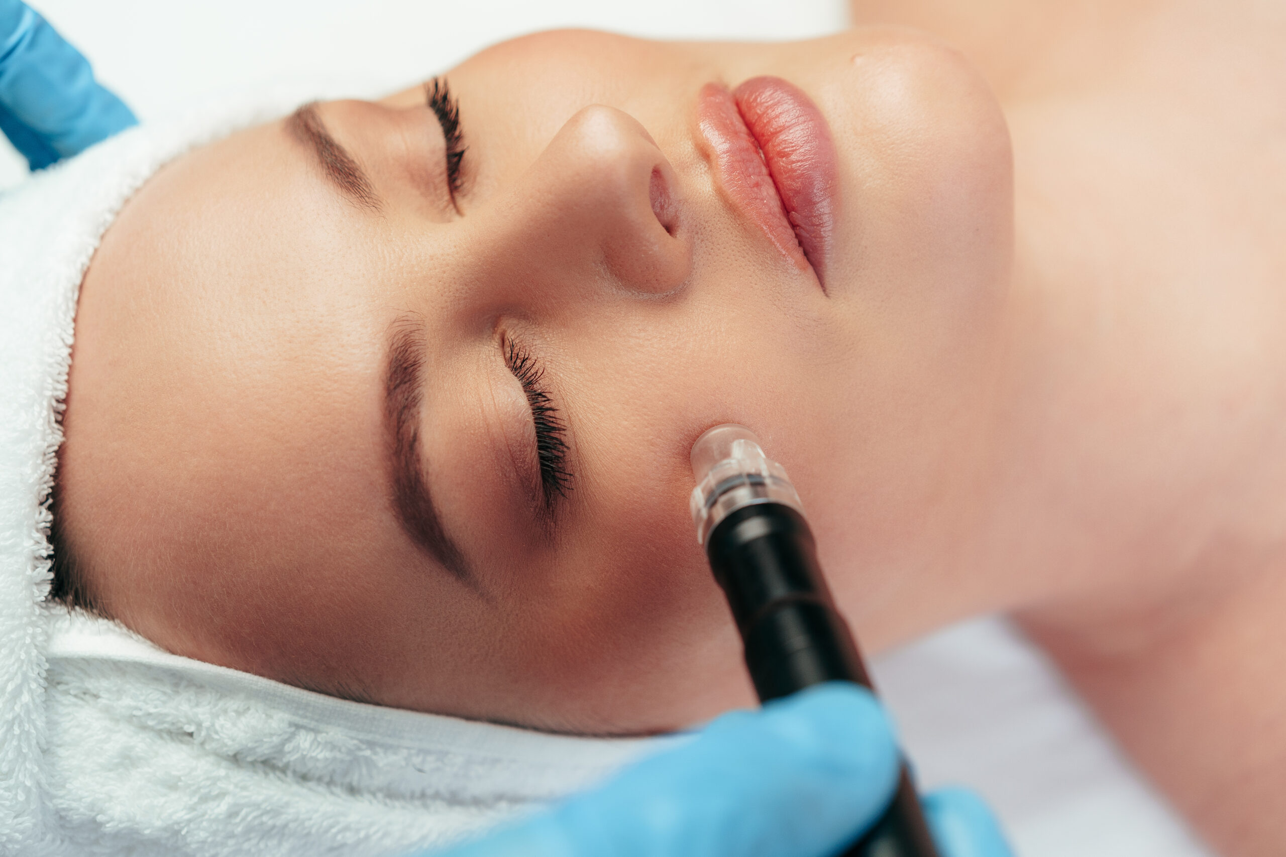 Collagen therapy through microneedling