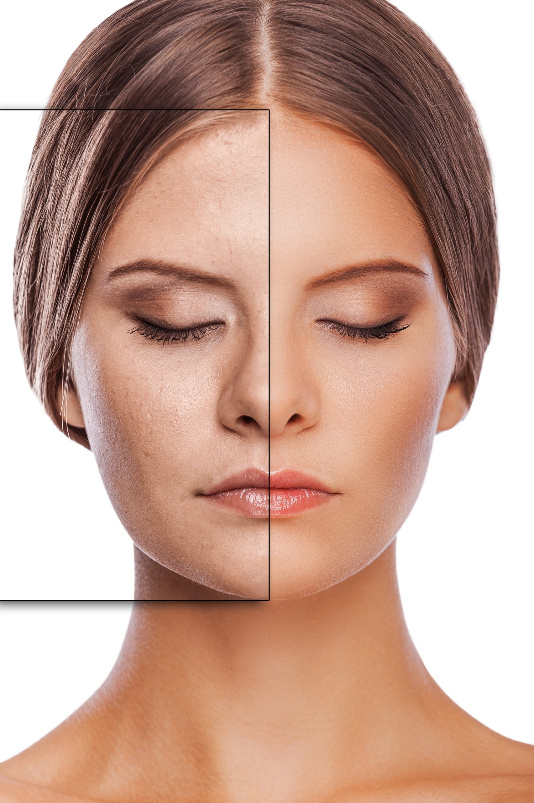 Chemical peel results before and after
