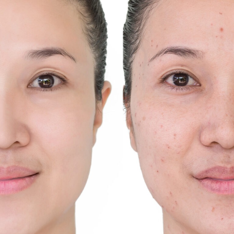Skin renewal after chemical peel