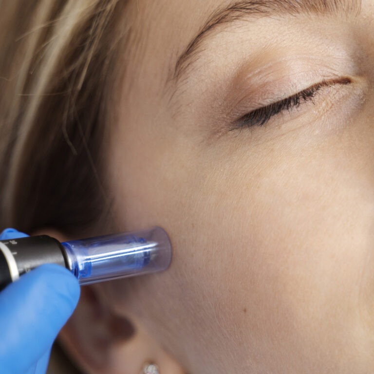 RF Microneedling treatment process