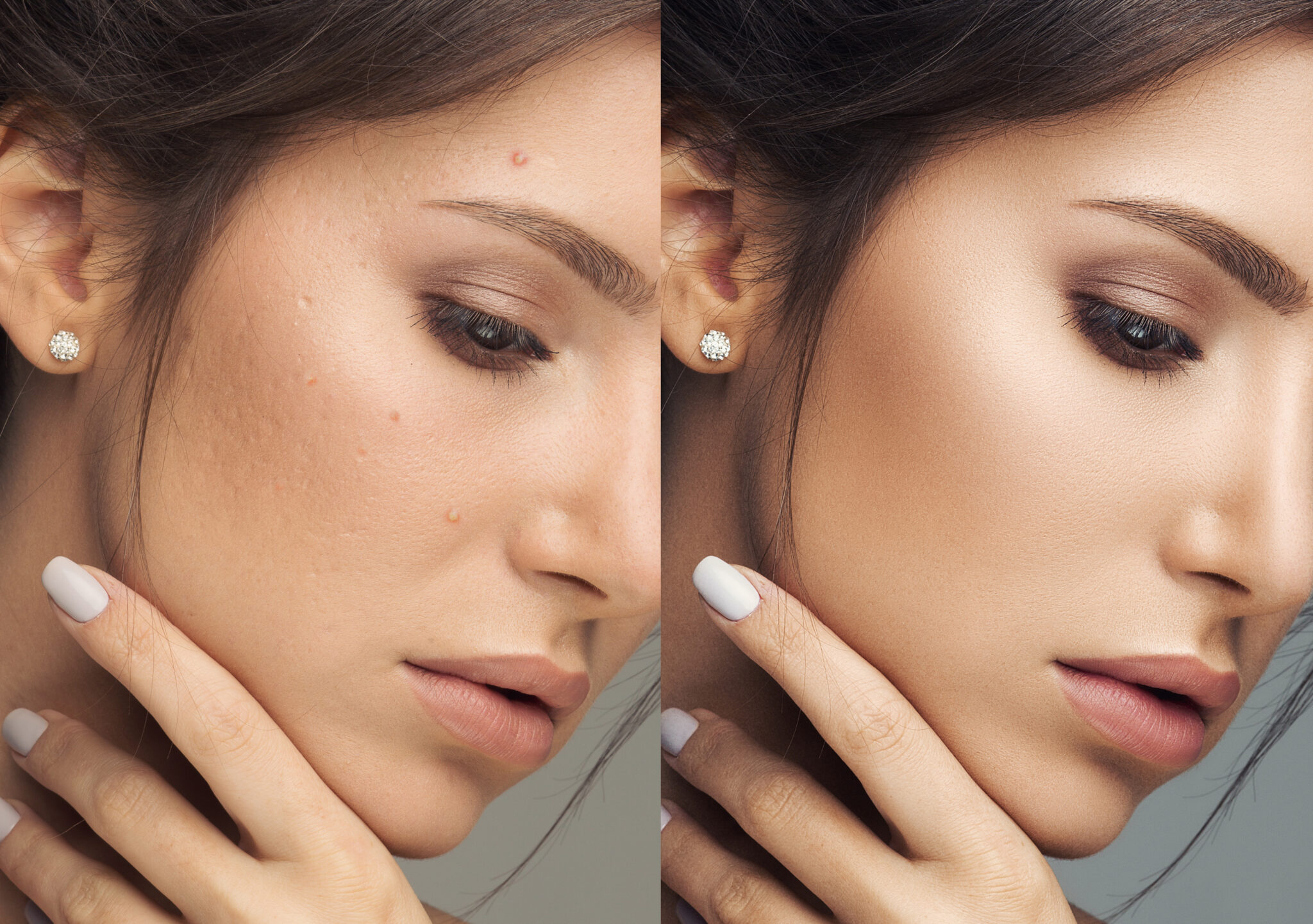 Before and after microneedling skin texture improvement