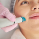 Professional microneedling treatment on facial skin