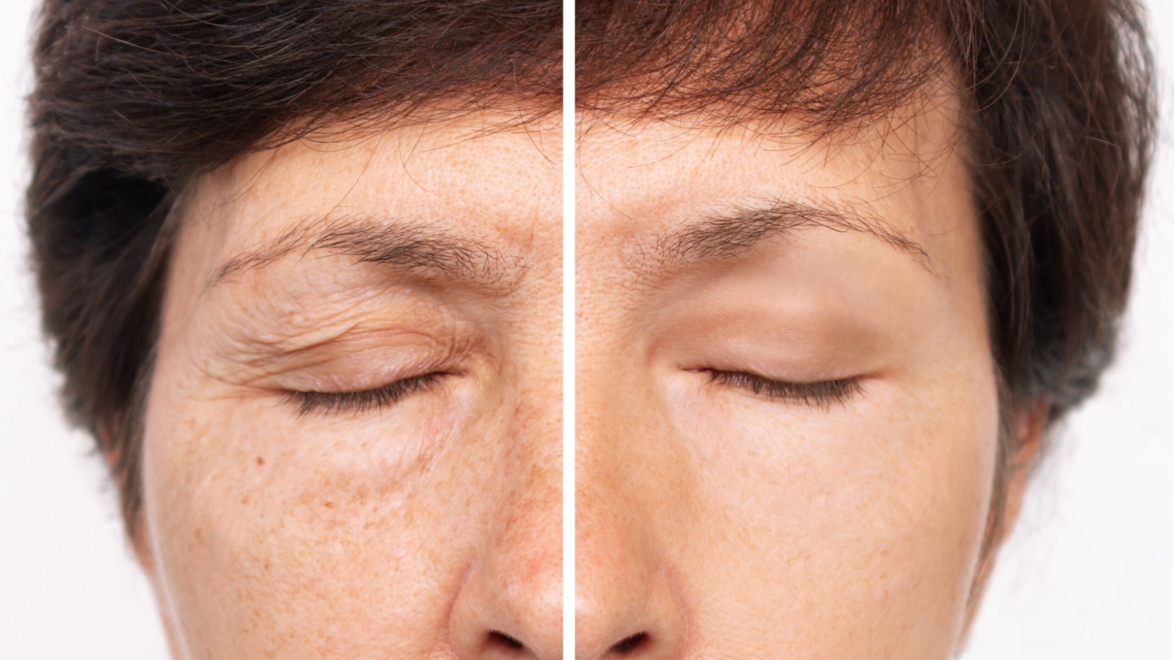 Before and after results of a chemical peel on aging, spot-prone skin.