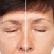 Before and after results of a chemical peel on aging, spot-prone skin.