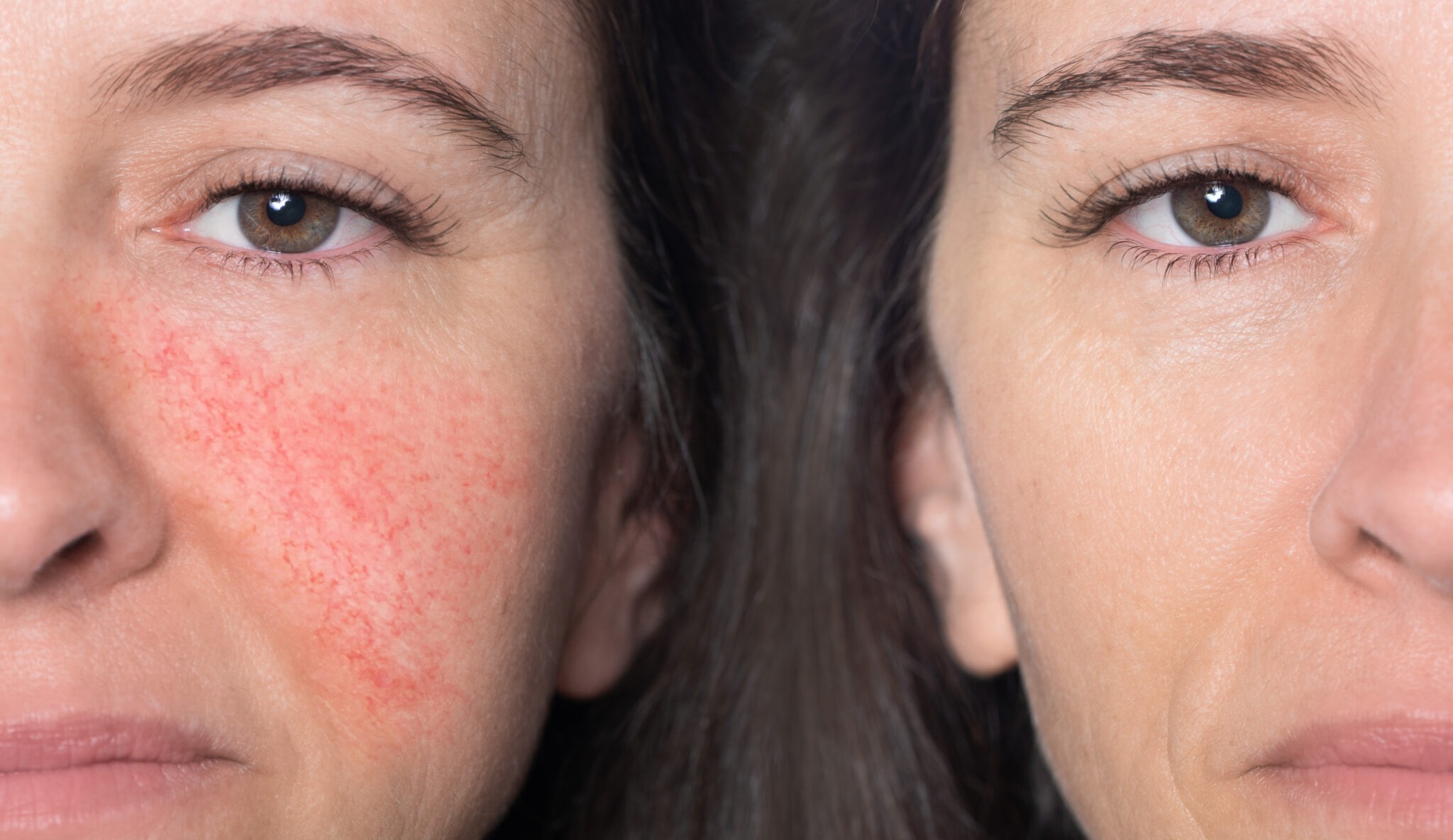 Before and after results of M22 IPL for rosacea