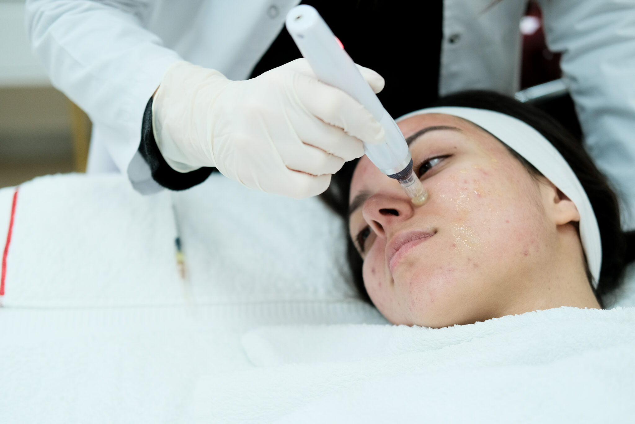 Secret RF treatment for acne scars on face
