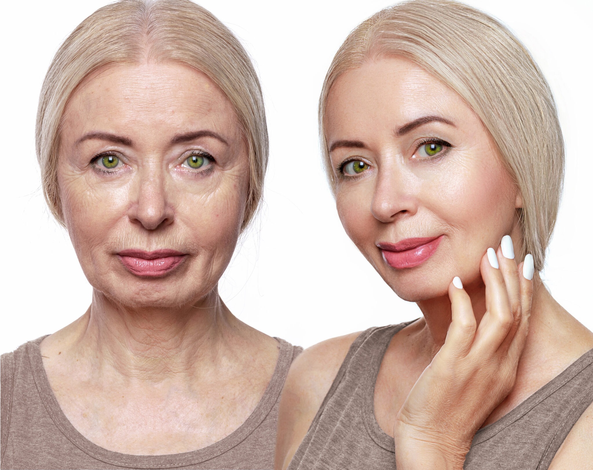 Before and after fractional CO₂ laser treatment for deep wrinkles