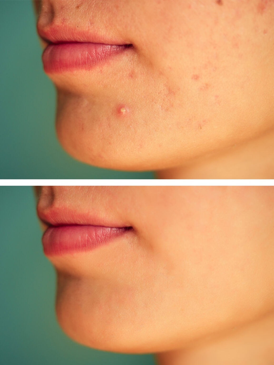 Fractional CO₂ laser treatment for acne scars