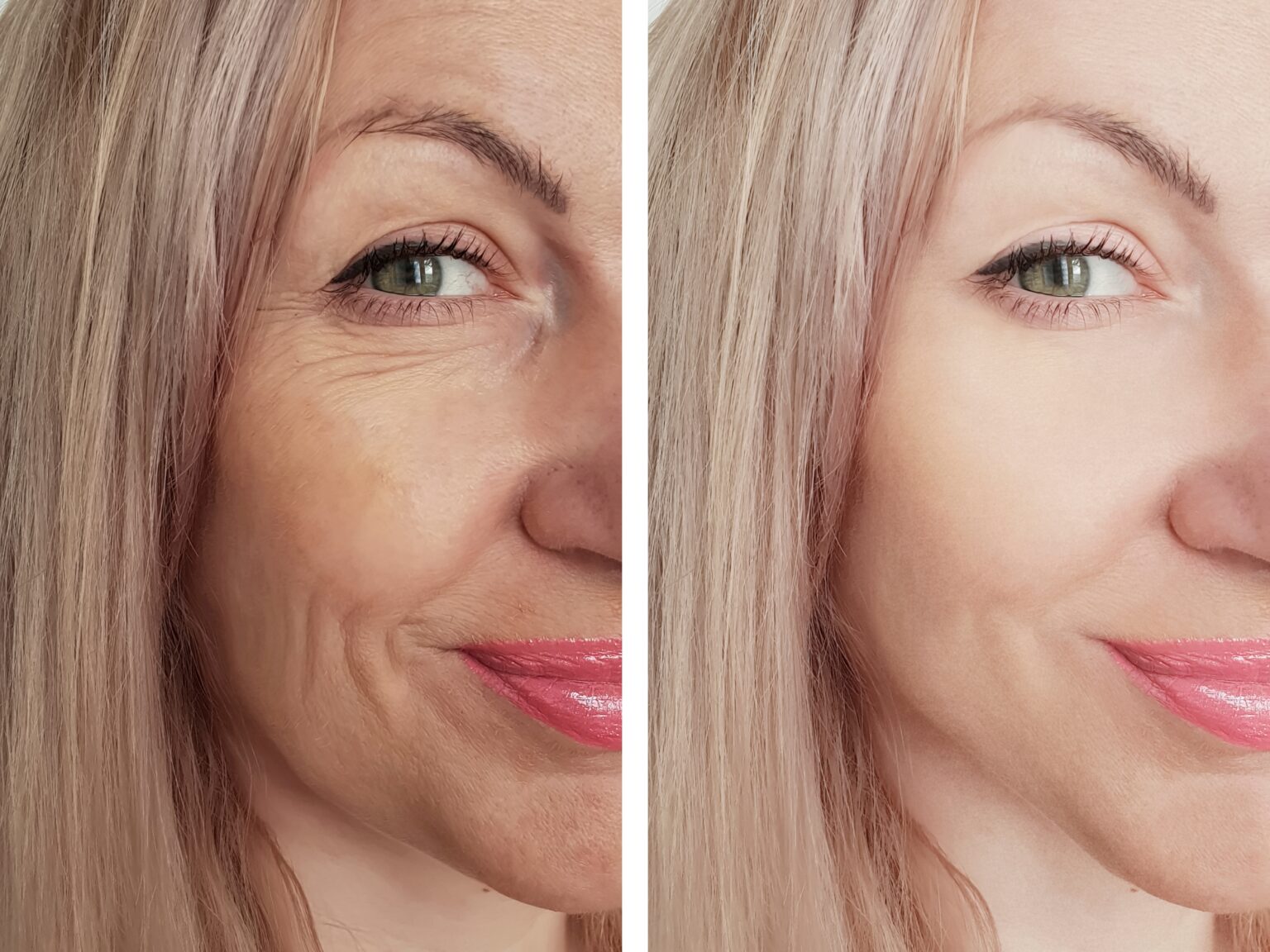 Before and after microneedling and collagen therapy