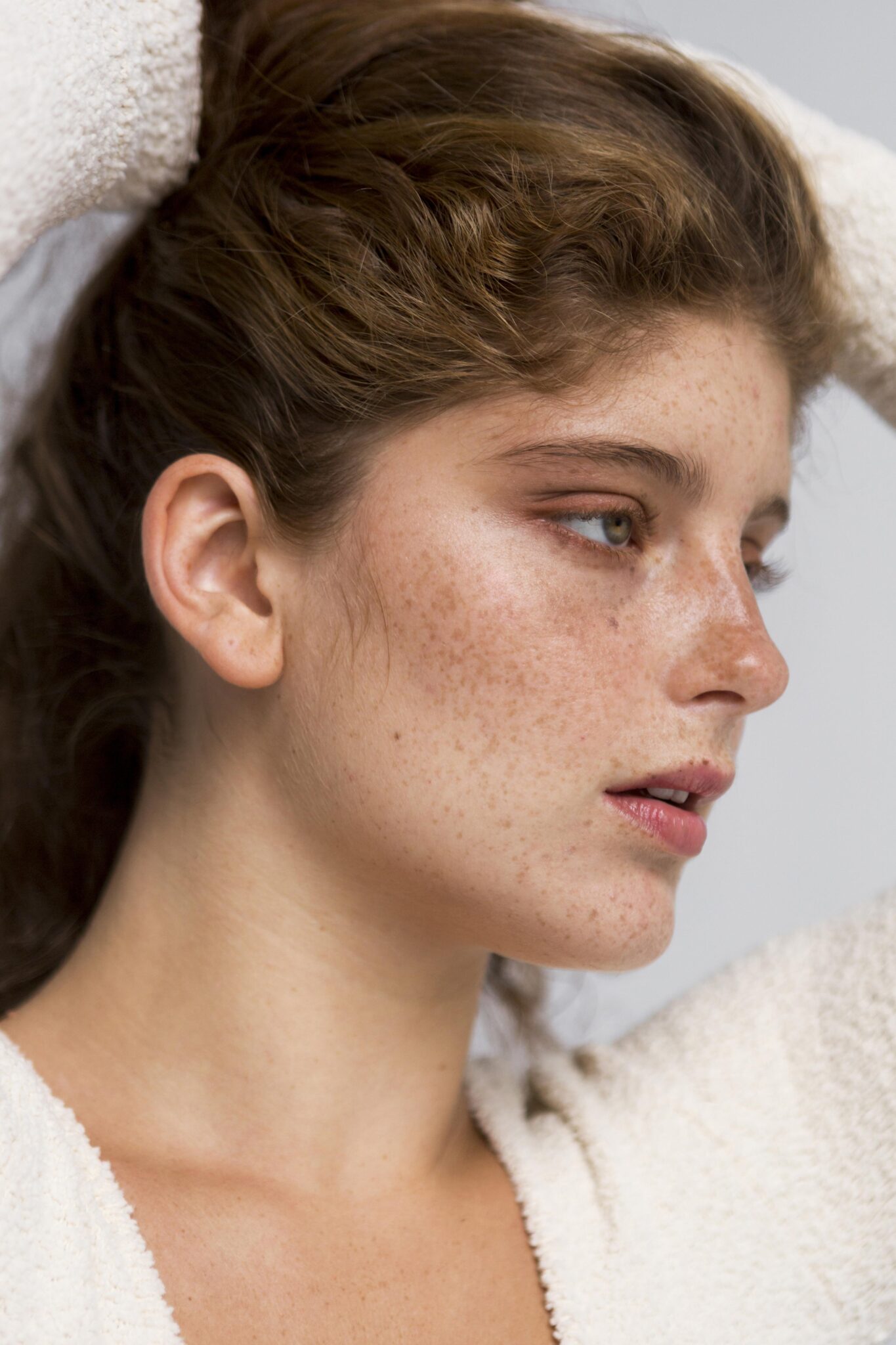 Sun-related pigmentation on facial skin